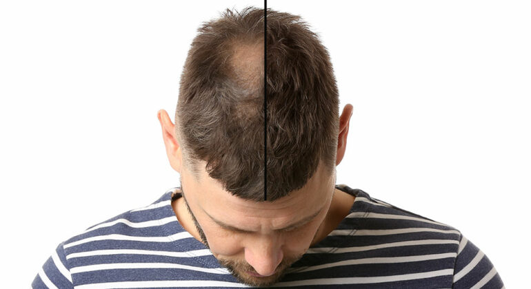 Know how laser caps help encourage hair growth