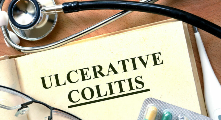 Ulcerative colitis – Causes, signs and management options