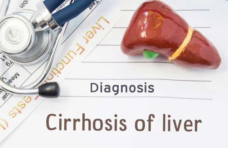 Liver Cirrhosis and its 4 Stages
