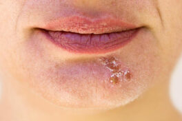 Popular essential oils to bid goodbye to cold sores