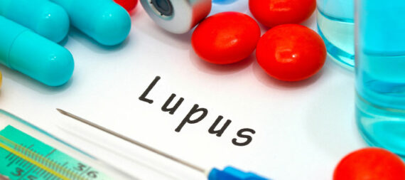 Avoid These 12 Triggers to Manage Lupus