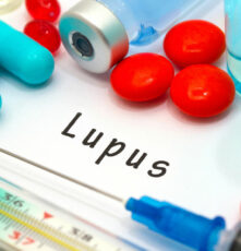Lupus – Symptoms, Risk Factors, and Diagnosis