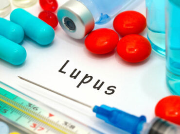 Lupus – Symptoms, Risk Factors, and Diagnosis