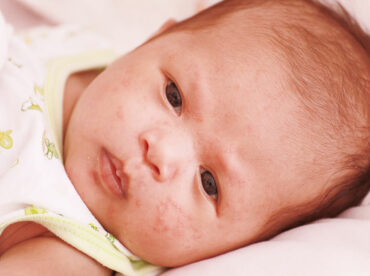 8 first-line treatments for atopic dermatitis in infants