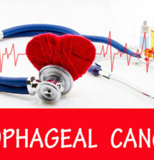 Esophageal cancer – Signs, causes, and management