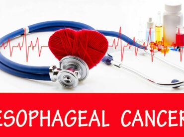 Esophageal cancer – Signs, causes, and management