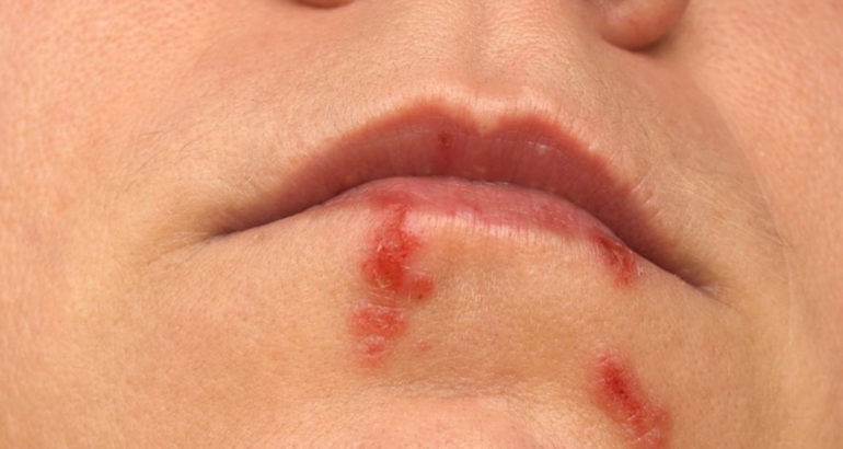 5 natural ways to deal with cold sore