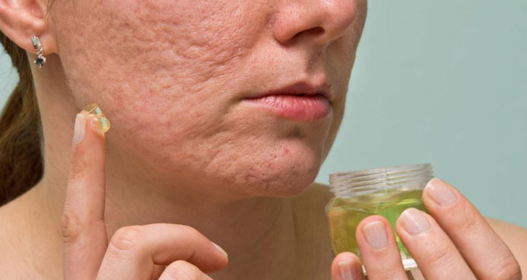 6 useful tips to treat acne scars, marks, and blemishes