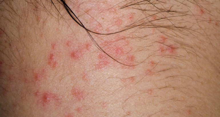 Here are a few common causes of atopic dermatitis