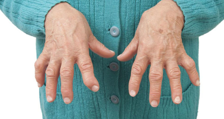Types of arthritis and ways to deal with them