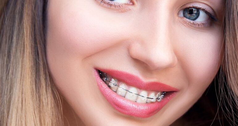 4 important tips to care for metal braces