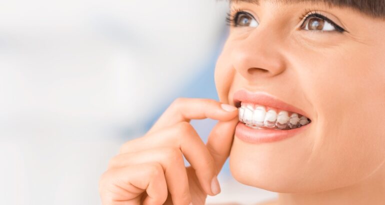 Important factors to consider before buying teeth aligners