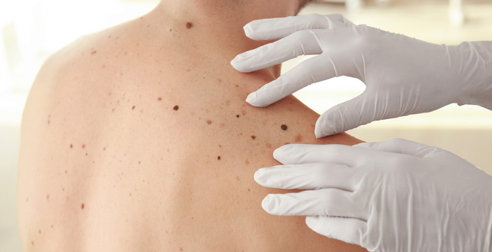 Common Treatments for Melanoma Skin Cancer » speakinghealth.com