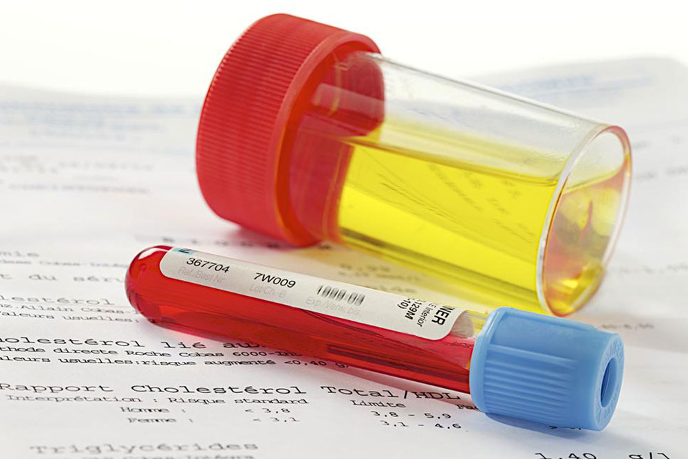 4 alarming reasons why blood appears in urine