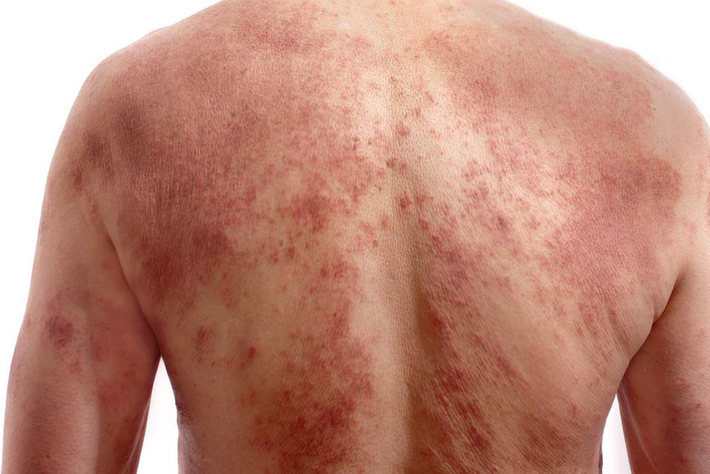 A few quick ways to identify chickenpox infection