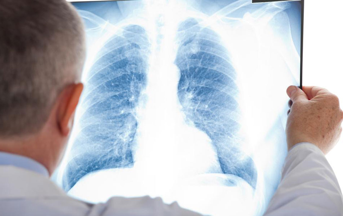 A few things you should know about mesothelioma cancer