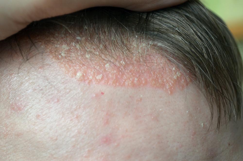 All you need to know about scalp psoriasis