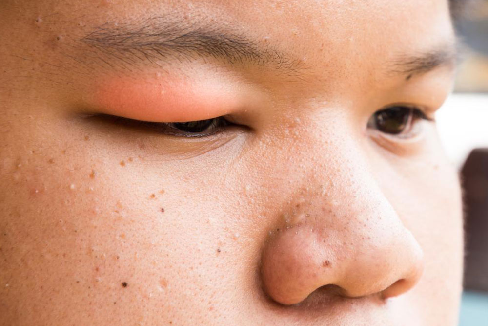 These are the causes of stye that you need to be aware of