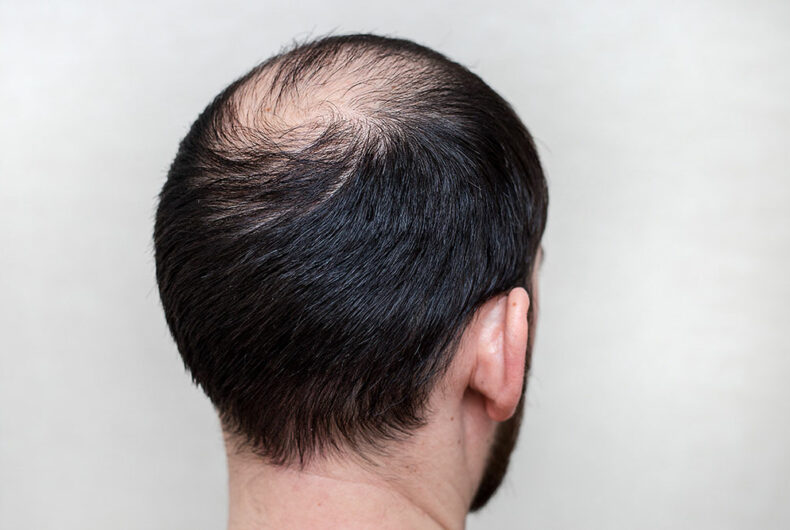 Male hair loss and its various aspects